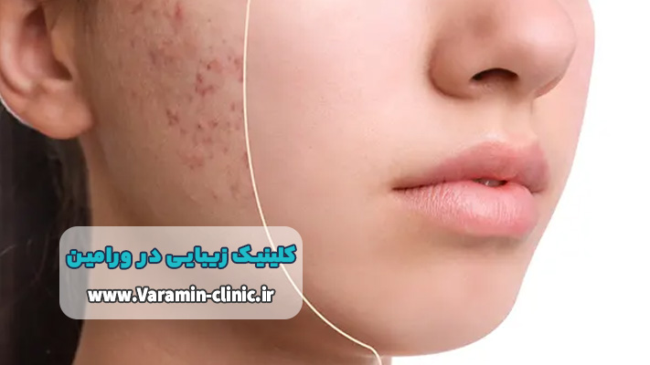 درمان اسکار و جای جوش در کلینیک زیبایی ورامین