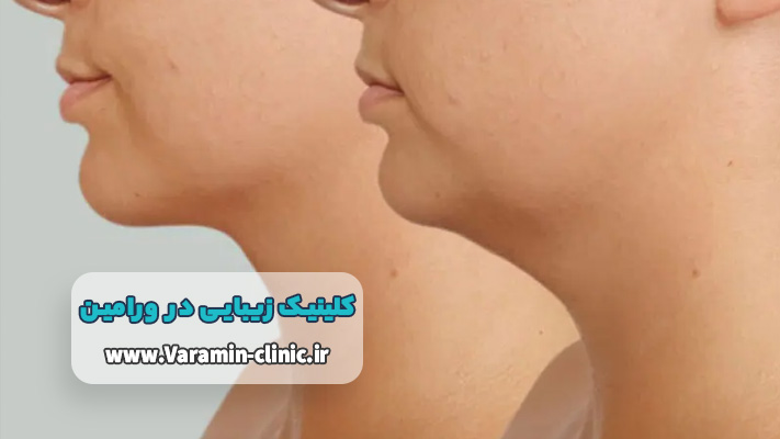 فع غبغب با استفاده از روش های غیرجراحی در کلینیک زیبایی ورامین